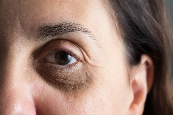 An extreme closeup view of an aging woman with wrinkles and crows feet. Dark rings are seen, common symptoms of aging, tiredness and stress