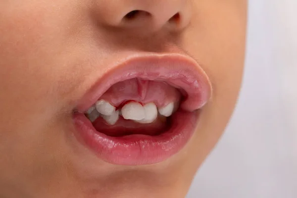 Extrem Närbild Munnen Ung Pojke Med Lossade Framtänder Blödande Tuggummi — Stockfoto