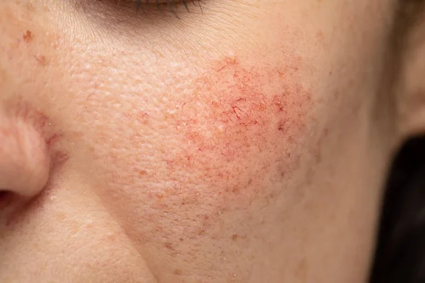 Kırmızı yanaklı, genç, beyaz bir bayanın yanağına yakın çekim görüntüsü. Genç yetişkinlerde rosacea ve dermatitin yaygın bir belirtisidir..