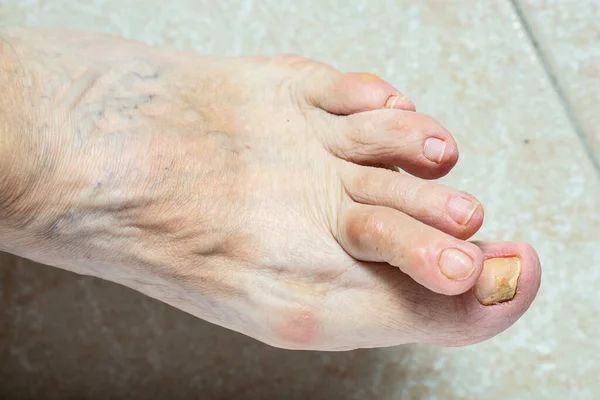 Voeten Oudere Vrouw Artritis Gele Nagels — Stockfoto