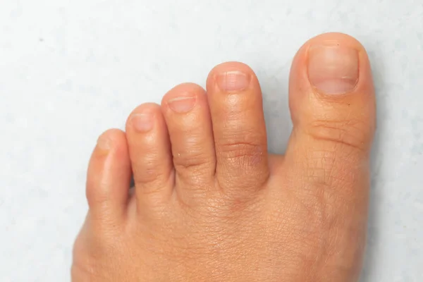多汗症による発汗過多の女性の足 — ストック写真