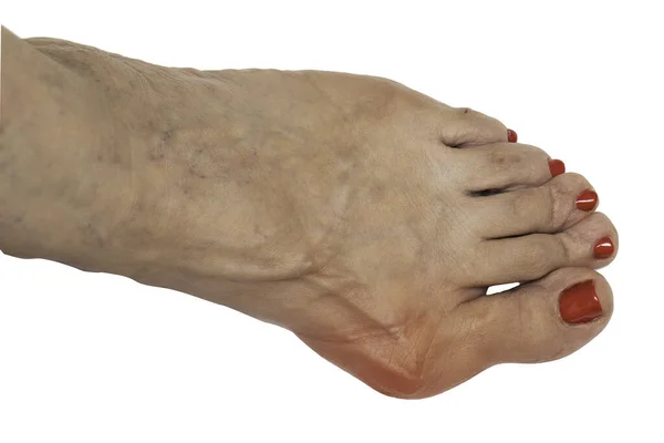 Closeup View Bare Foot Elderly Woman Showing Painful Swollen Case — Stock Photo, Image