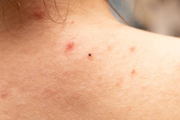 seen from the shoulders with acne skin, concept of skin disorder