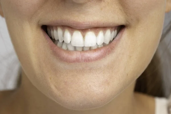 Konceptualny Obraz Dziewczyny Zgrzytającej Zębami Powodu Bruksizmu — Zdjęcie stockowe
