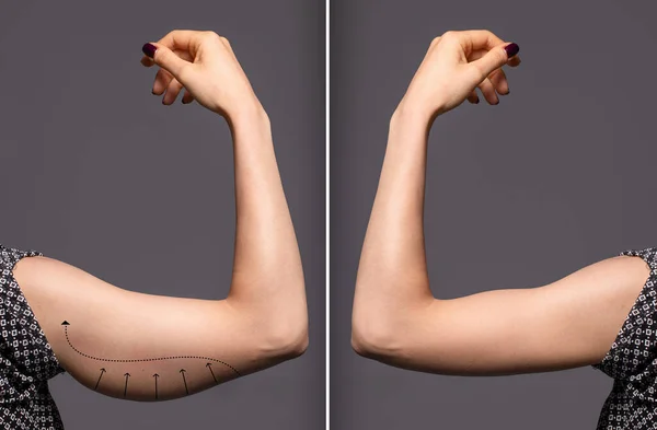 A before and after view on the arm of a young Caucasian woman