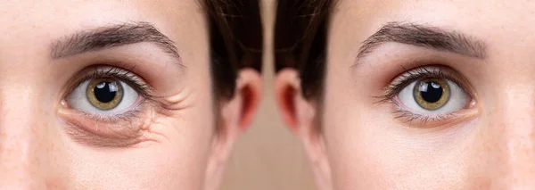 Przed Widoku Zabiegu Blepharoplastyki Pięknej Białej Damy Operacji Plastycznej Oczu — Zdjęcie stockowe