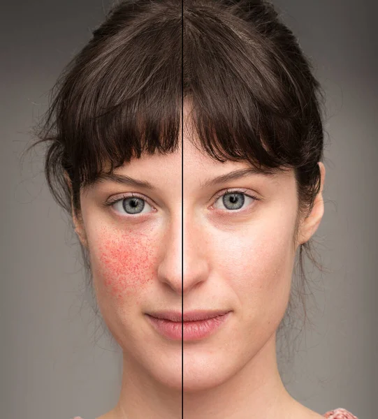 Rosacea 'dan muzdarip beyaz güzel bir kızın öncesi ve sonrası. Başarılı lazer ameliyatının sonuçlarını gösteren portre görünümü.