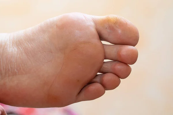 close-up of the sole of the foot of a white adult man showing calluses