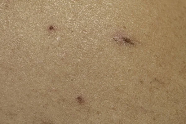 Torra Skorpor Huden Dermatit Nära Håll — Stockfoto