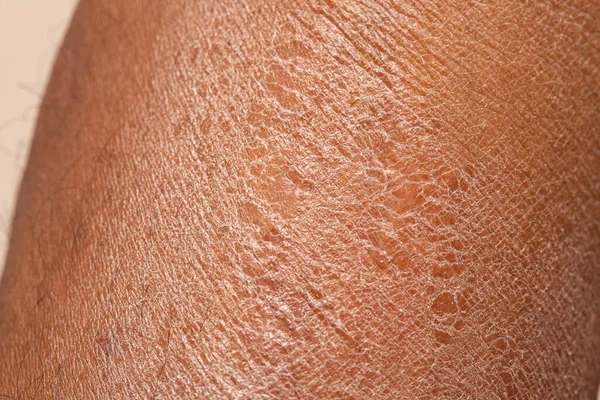 皮膚疾患 乾燥した脱水肌の予防コンセプト — ストック写真