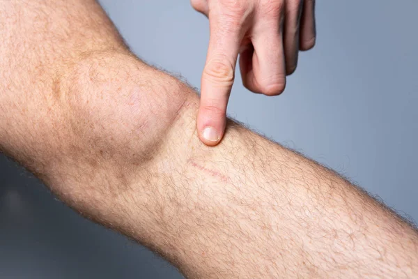 Man Showing Healed Scar Leg — Stock Photo, Image