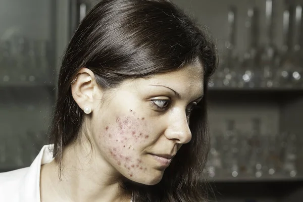 Professional Successful Scientist Woman Seen Bad Acne Skin Problems Side — Stock Photo, Image