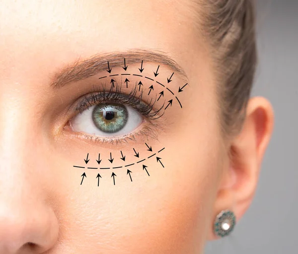 Blefaroplastik Behandling Kvinnliga Ögon — Stockfoto