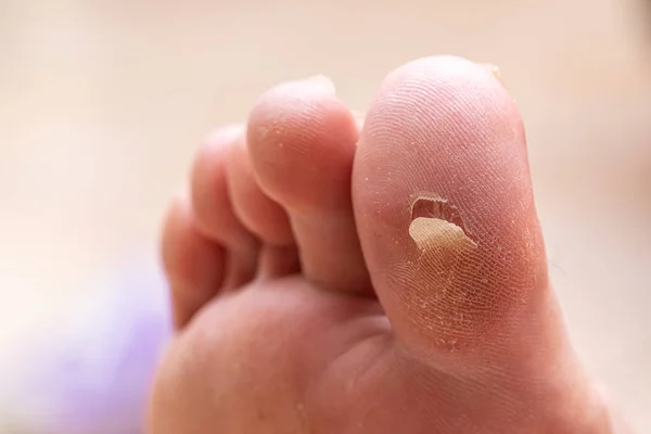 Callus Cassé Dans Gros Orteil Avec Peau Sèche Déshydratée — Photo