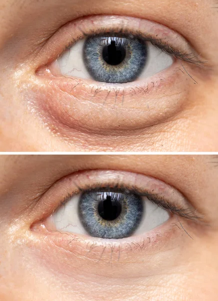 在一个年轻的白人女孩的眼睛上有一个分裂的屏幕视图 一个显示眼睛下方的液体保持 另一个显示了眼睑整形手术的结果 — 图库照片