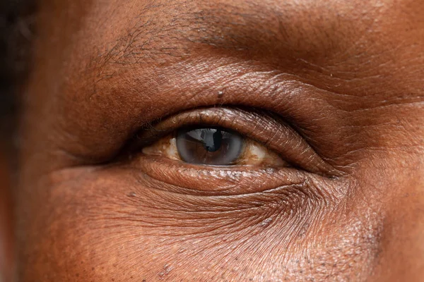 Una Visión Macro Ojo Abuelo Africano Una Catarata Nublada Detalle —  Fotos de Stock