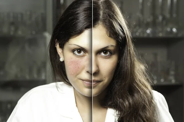 Portrait Professional Woman Who Suffered Rosacea Resulting Rosy Red Cheeks — Stock Photo, Image