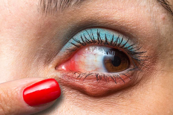 Red eye with chalazion and a finger indicating it