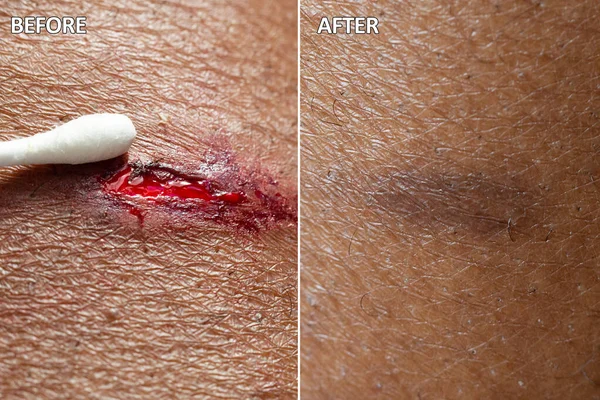Before and after a healing treatment on a wound on the skin