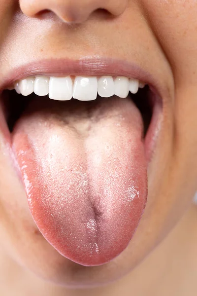 Extreme Closeup View Tongue Young Caucasian Lady Suffering Oral Candidiasis — Stock Photo, Image