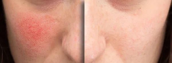 View Rosacea Treatment Young Caucasian Woman Shows Results Laser Surgery — Stock Photo, Image