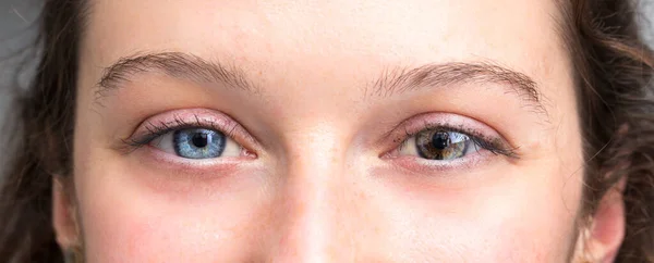 Heterocromia Iridium Humano Olhos Mulher Mostrando Diferença — Fotografia de Stock