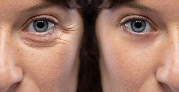 Ojos Arrugados Con Patas Gallo Antes Después Del Tratamiento Cosmético — Foto de Stock