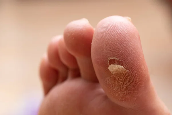 Hallux Ayak Parmağı Üzerinde Nasır Gösteren Bir Kişinin Ayağında Yakın — Stok fotoğraf