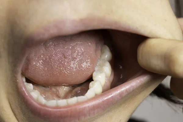 Dentes Molares Inferiores Fechar — Fotografia de Stock