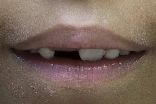 Ekstremalne Zbliżenie Ćmę Usta Młodego Chłopca Brakującym Przednim Zębem Dziecięcą — Zdjęcie stockowe