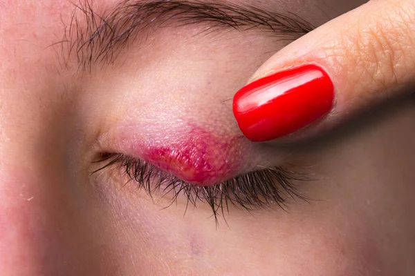 Chalazion Reddened Eyelid Female Eye — Stock Photo, Image