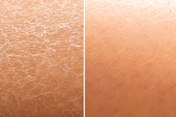 Před Hydrataci Kůže Vidět Detailu Sušenou Popraskané Kůže Proti Bezchybné — Stock fotografie