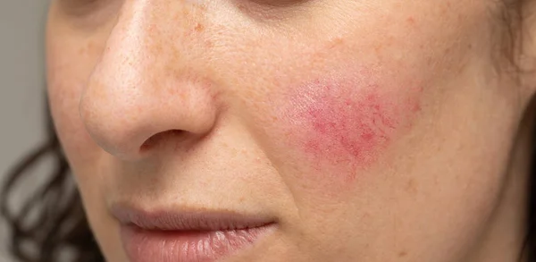 Mujer Con Manchas Mejilla Causadas Por Una Infección Bacteriana —  Fotos de Stock
