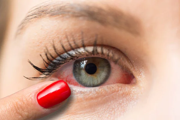 Finger Zeigt Frau Rotes Auge — Stockfoto
