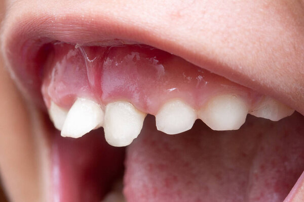 Crooked teeth in children mouth