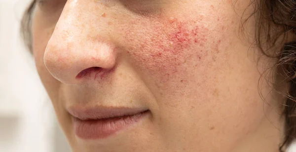 Yanaklarında ve burnunun altında rosacea olan genç bir kadının yakın plan görüntüsü. Kırmızı lekeler ve belirgin kan damarları ayrıntılı olarak görülüyor..