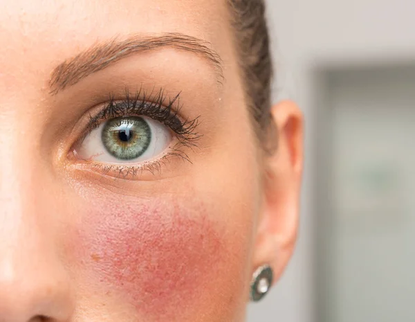 Güzel, genç, beyaz bir bayan yakından görülüyor. Önden, yeşil iris ve siyah rimelin detaylı görüntüsü. Kırmızı benekli yanaklar, rosacea belirtileri..