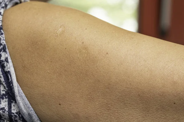 Una Vista Cerca Parte Superior Del Brazo Una Señora Caucásica — Foto de Stock