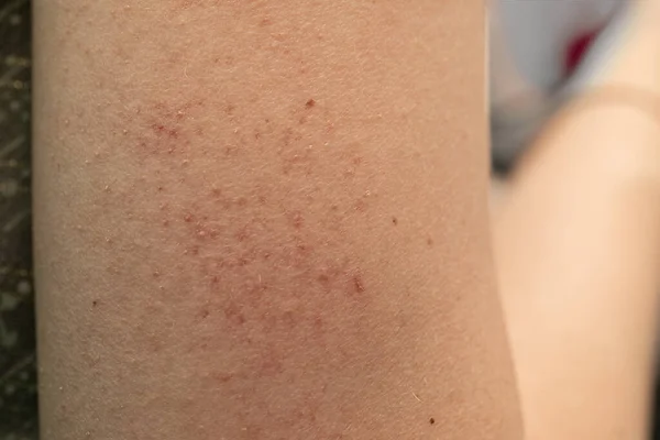 一位皮肤敏感的年轻白人妇女手臂上的红斑接触性皮炎特写 — 图库照片