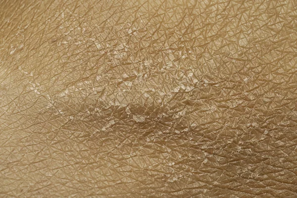A macro view of human skin filling the frame, details of the lines and cracks and flaky shedding skin, skincare and dermatology concept with room for copy.