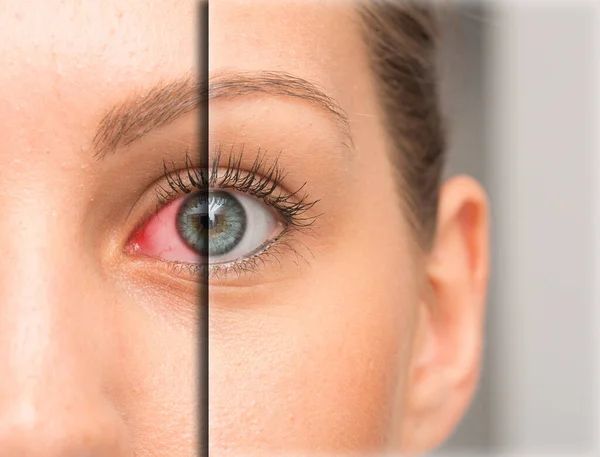 Rote Augen Vor Und Nach Der Augentropfenbehandlung — Stockfoto