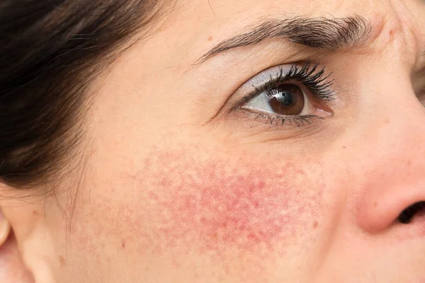Frowning Caucasian Woman Seen Close Side Upset Severe Case Rosacea — Stock Photo, Image