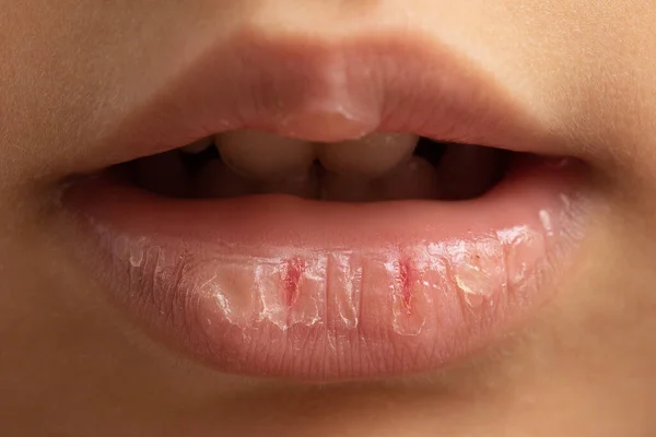 Natuurlijke Remedies Voor Gebarsten Lippen Jonge Leeftijd Concept Van Huidverzorging — Stockfoto