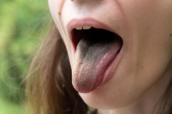 黒い毛むくじゃらの舌を持つ少女を間近で見ることができる 腸内細菌叢の細菌感染症の症状 左側のスペースのコピー — ストック写真