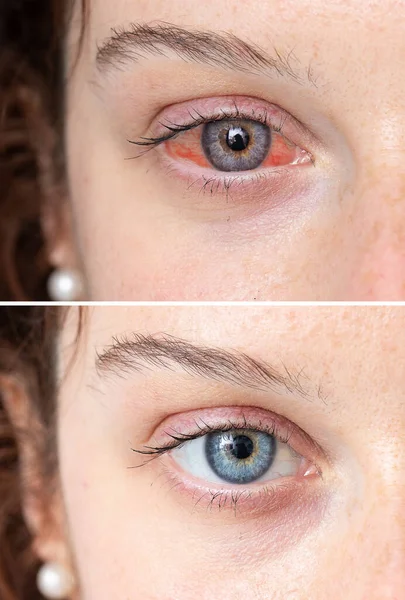 Olhar Intenso Menina Com Olho Azul Profundo Antes Depois Tratamento — Fotografia de Stock