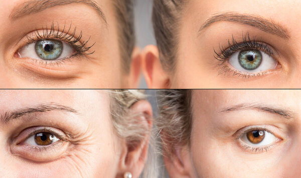 Comparison between woman eye bags before and after cosmetic trea