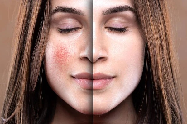 A young woman in her early twenties shows before and after results of successful light treatment to clear the cheeks from dilated blood vessels and red blotches.