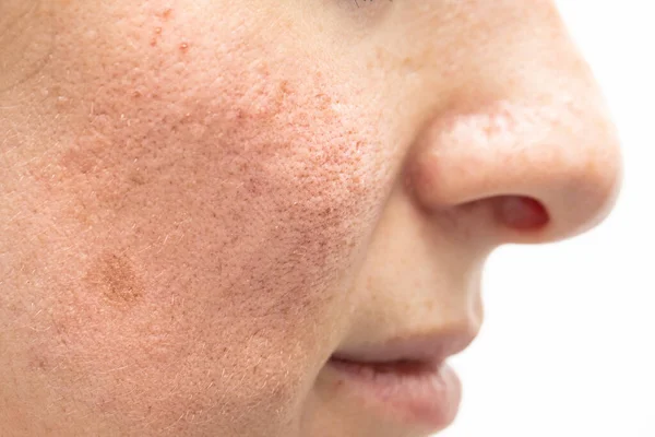 若い白人女性の頬と鼻についての側面とプロフィールビュー 酒さの症状を除去するレーザー手術を受けた後 赤と赤面 — ストック写真