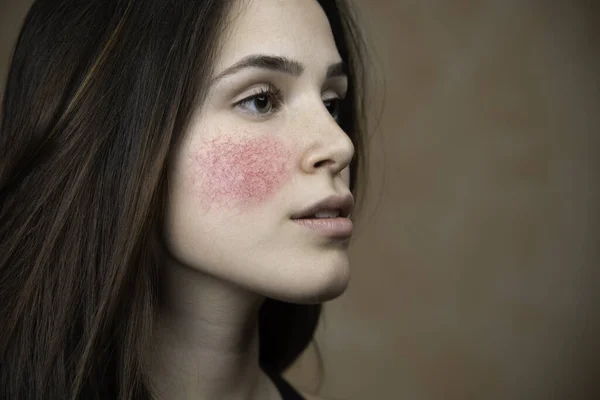 Vacker Ung Kvinna Med Rosacea — Stockfoto