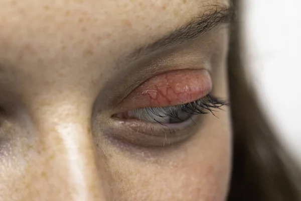 Extreme Closeup View Eye Young Caucasian Woman Suffering Stye Upper — Stock Photo, Image